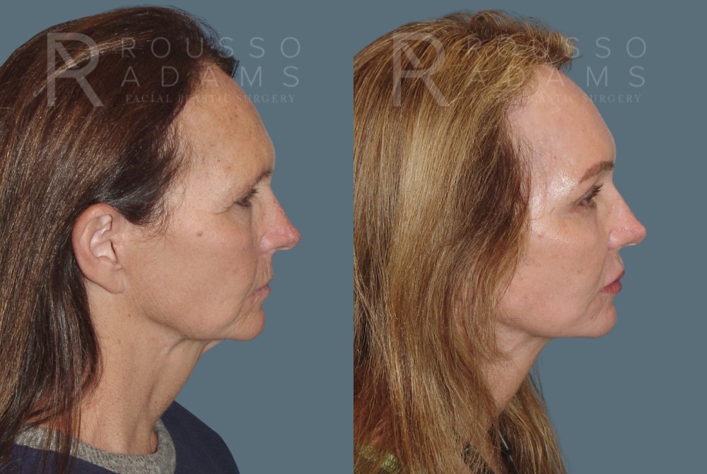 Skin Rejuvenation Before & After Gallery - Patient 139027 - Image 3