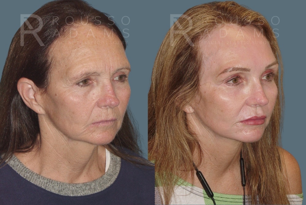 Skin Rejuvenation Before & After Gallery - Patient 139027 - Image 2