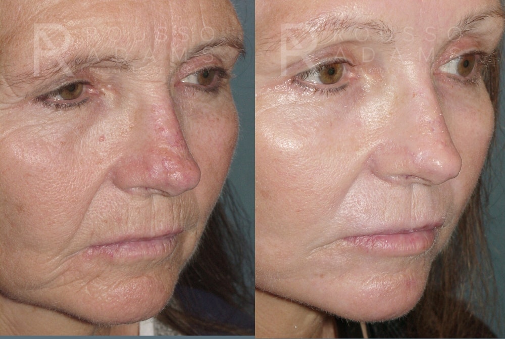 Skin Rejuvenation Before & After Gallery - Patient 139027 - Image 4