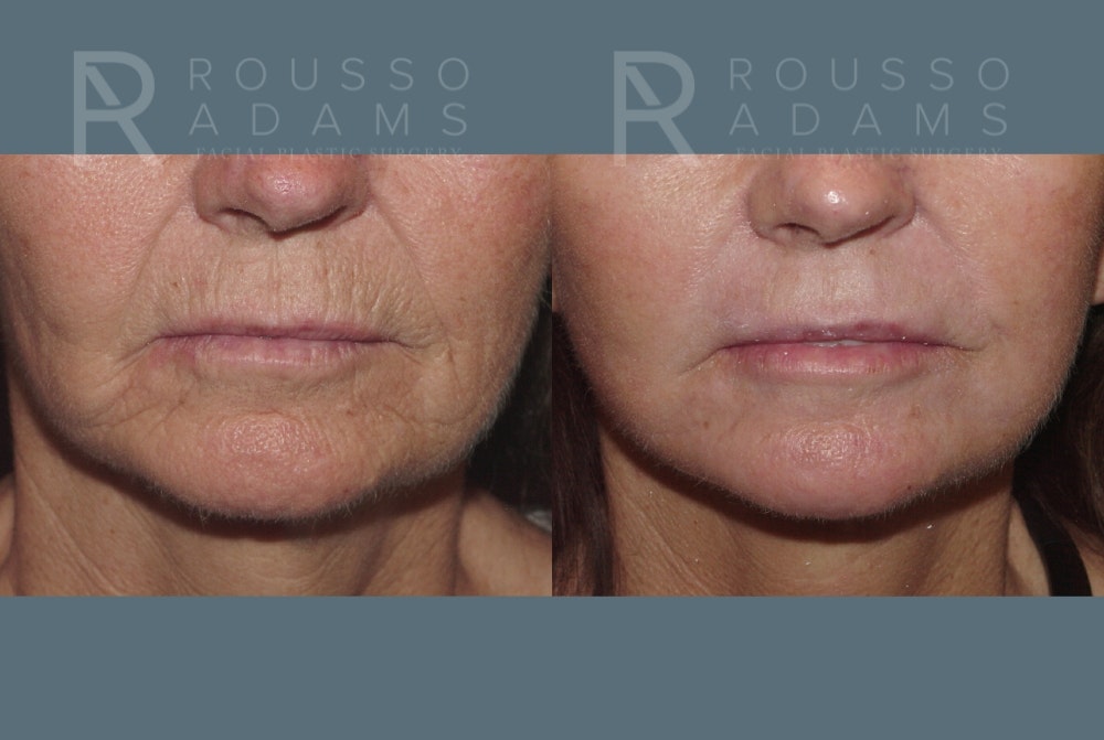 SculptLift™ Before & After Gallery - Patient 334216 - Image 5