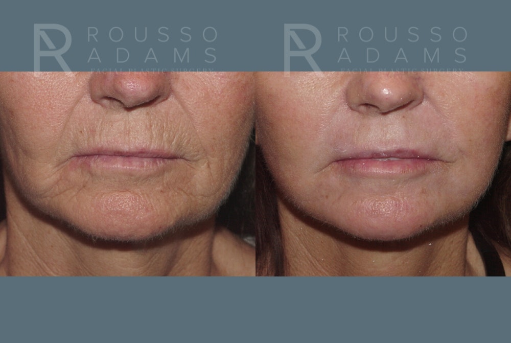 Skin Rejuvenation Before & After Gallery - Patient 139027 - Image 5