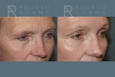Skin Rejuvenation Before & After Gallery - Patient 139027 - Image 6