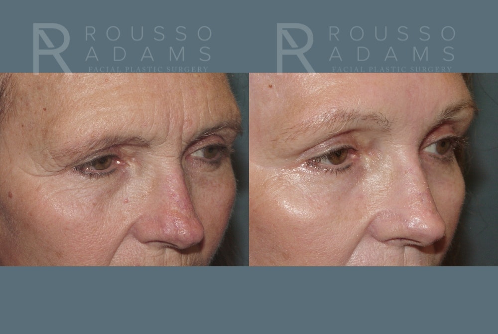 Skin Rejuvenation Before & After Gallery - Patient 139027 - Image 6