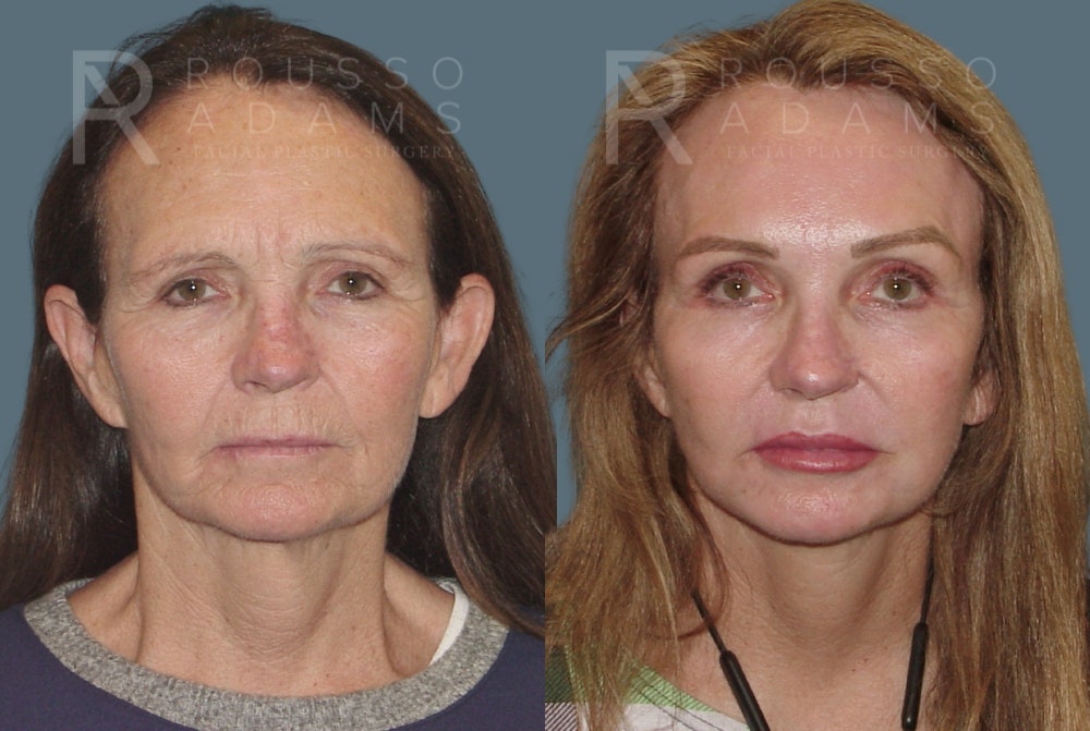 Skin Rejuvenation Before & After Gallery - Patient 139027 - Image 1