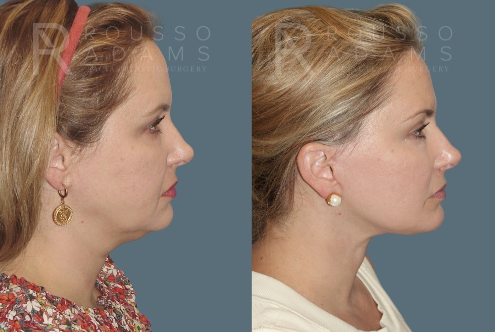 SculptLift™ Before & After Gallery - Patient 116278 - Image 3