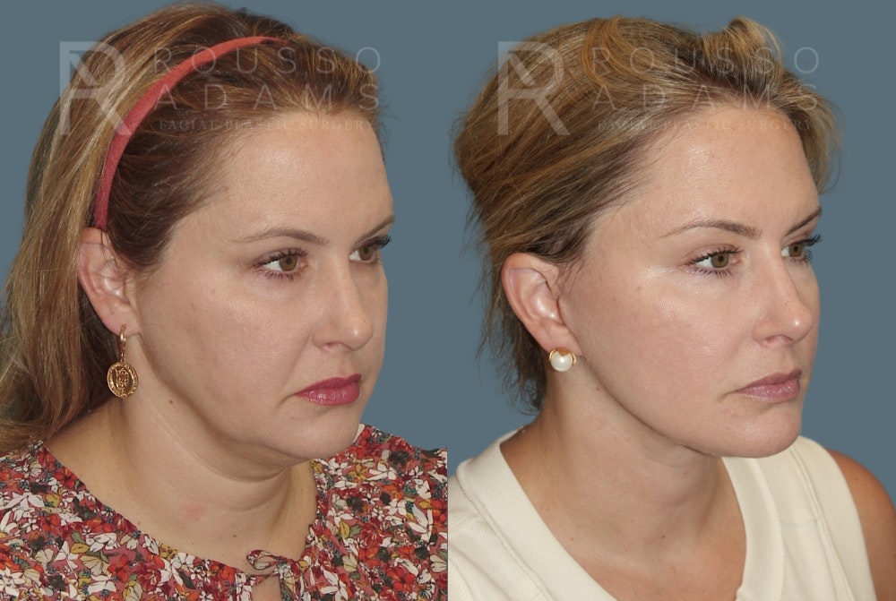 SculptLift™ Before & After Gallery - Patient 116278 - Image 2