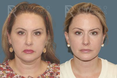SculptLift™ <span class=small>By Dr. Daniel Rousso</span> Before & After Gallery - Patient 116278 - Image 1