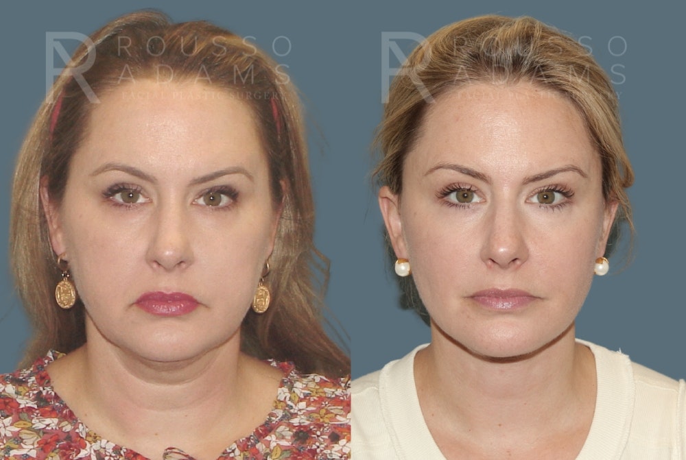 SculptLift™ <span class=small>By Dr. Daniel Rousso</span> Before & After Gallery - Patient 116278 - Image 1