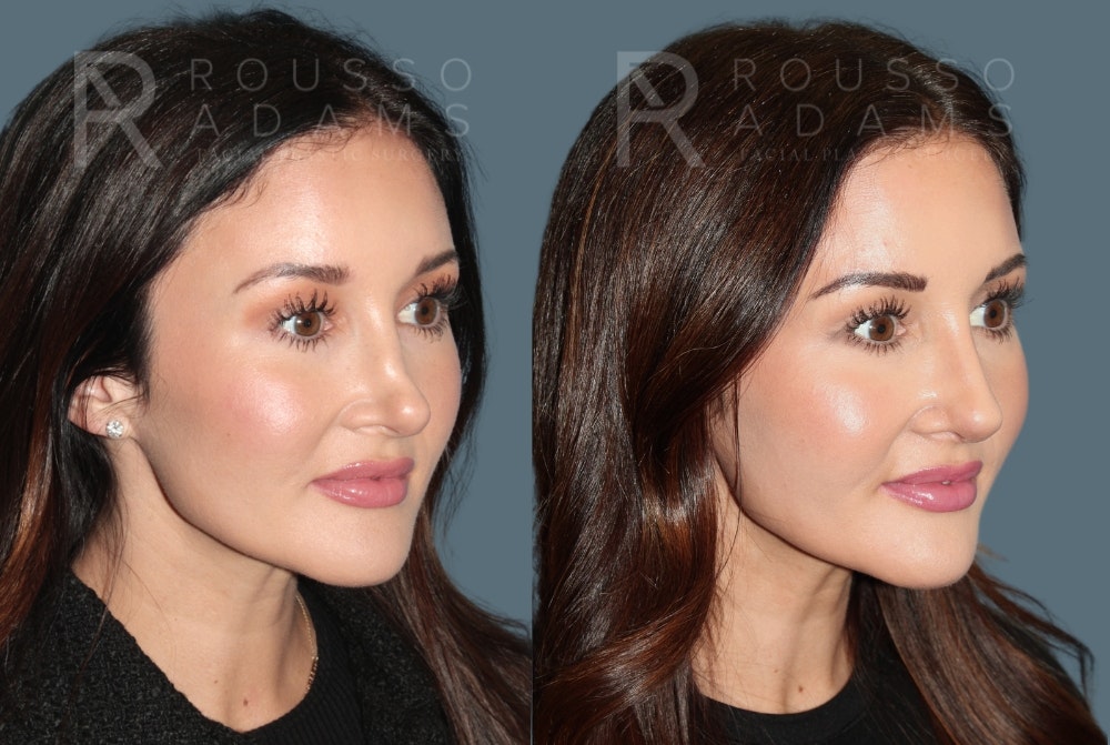 Revision Rhinoplasty <span class=small>By Dr. Daniel Rousso</span> Before & After Gallery - Patient 594400 - Image 1