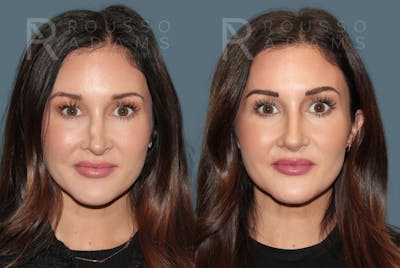 Revision Rhinoplasty <span class=small>By Dr. Daniel Rousso</span> Before & After Gallery - Patient 594400 - Image 2