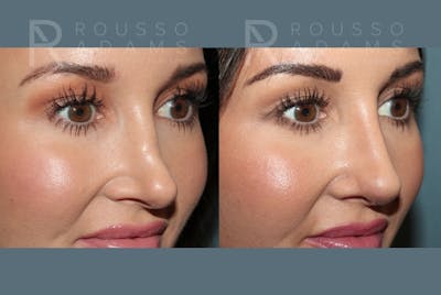 Revision Rhinoplasty <span class=small>By Dr. Daniel Rousso</span> Before & After Gallery - Patient 594400 - Image 4