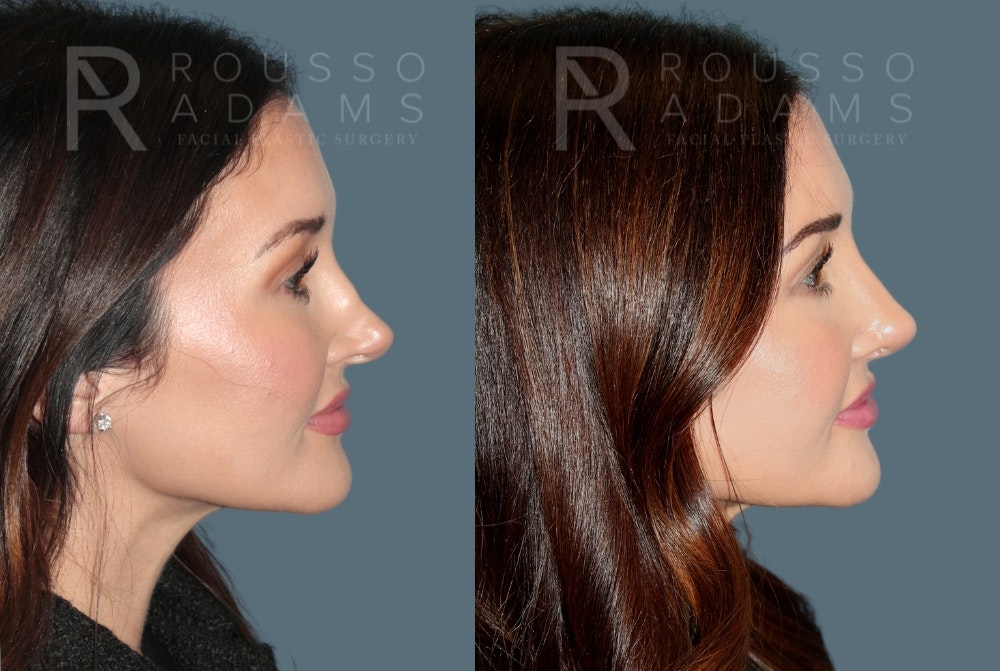 Revision Rhinoplasty <span class=small>By Dr. Daniel Rousso</span> Before & After Gallery - Patient 594400 - Image 3