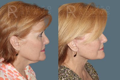 Deep Plane Facelift Before & After Gallery - Patient 382528 - Image 2
