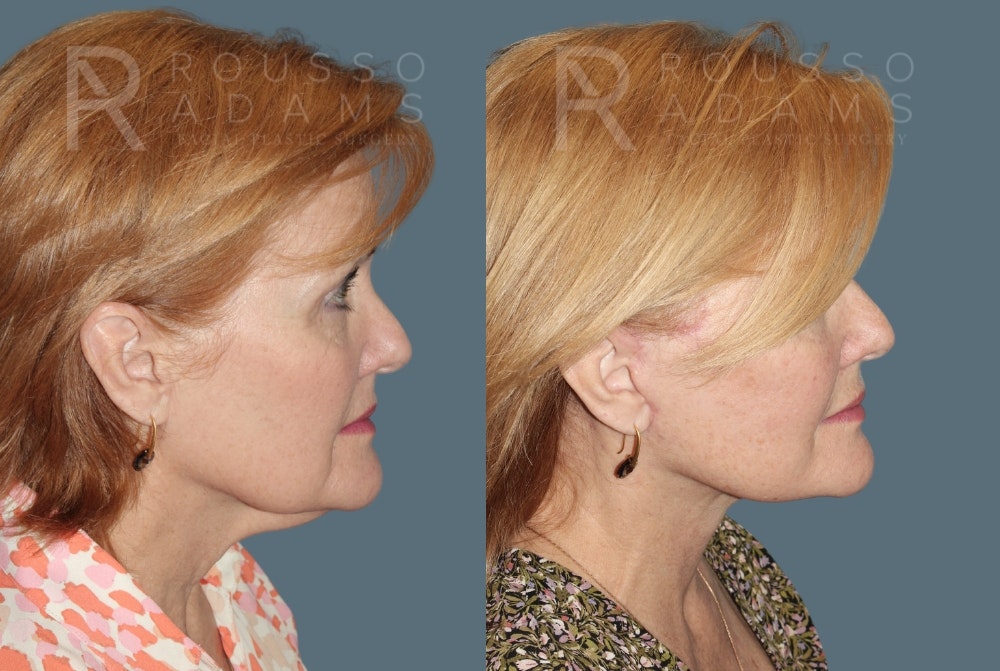 Deep Plane Facelift Before & After Gallery - Patient 382528 - Image 2