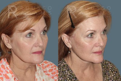 Deep Plane Facelift Before & After Gallery - Patient 382528 - Image 1