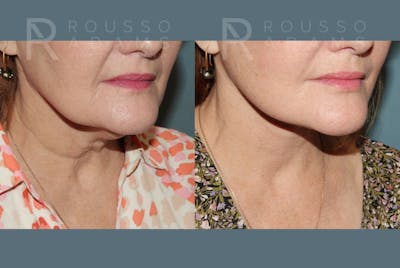 Deep Plane Facelift <span class=small>By Dr. Austin Adams</span> Before & After Gallery - Patient 382528 - Image 4