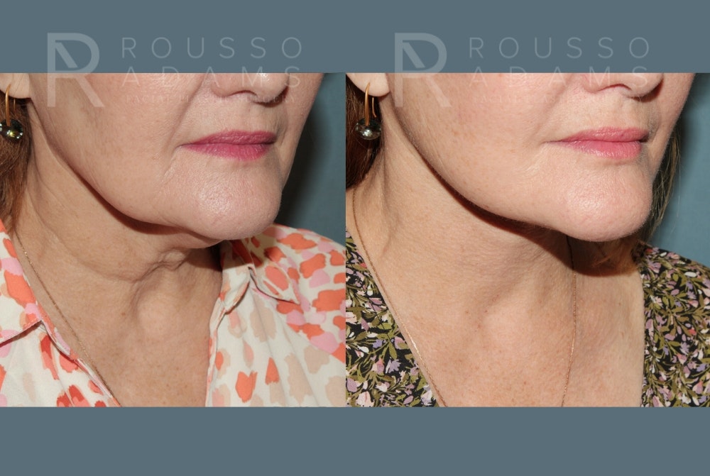 Deep Plane Facelift <span class=small>By Dr. Austin Adams</span> Before & After Gallery - Patient 382528 - Image 4