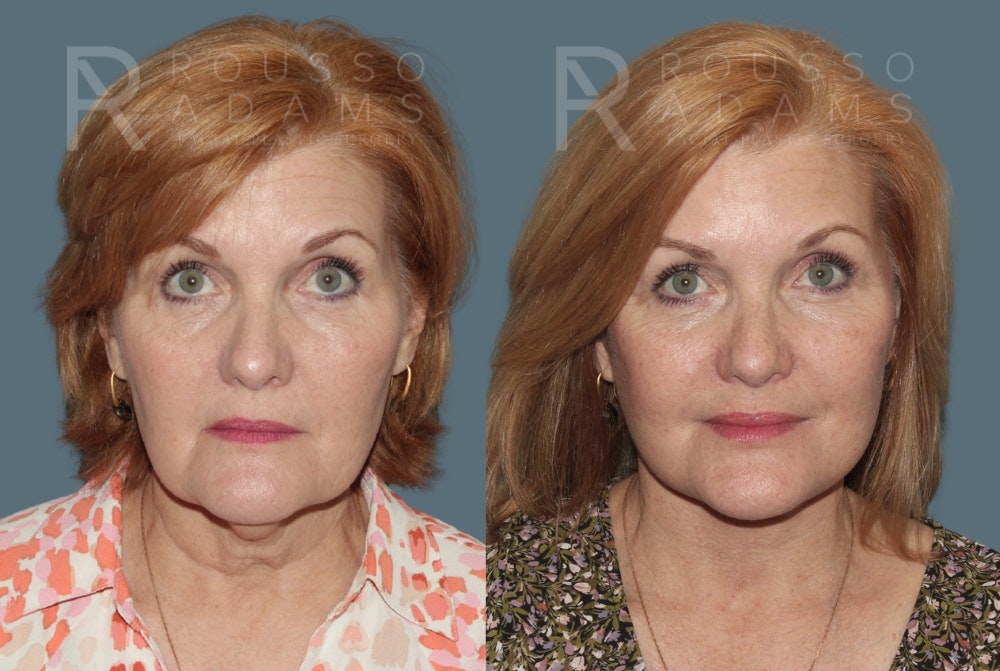 Deep Plane Facelift Before & After Gallery - Patient 382528 - Image 3