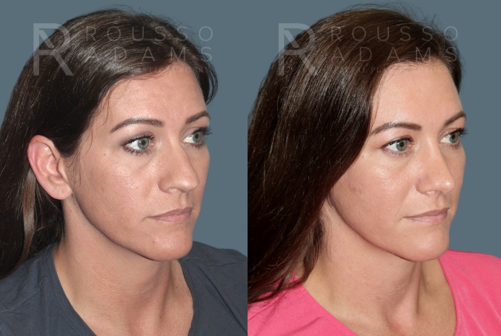Rhinoplasty Before & After Gallery - Patient 325523 - Image 2