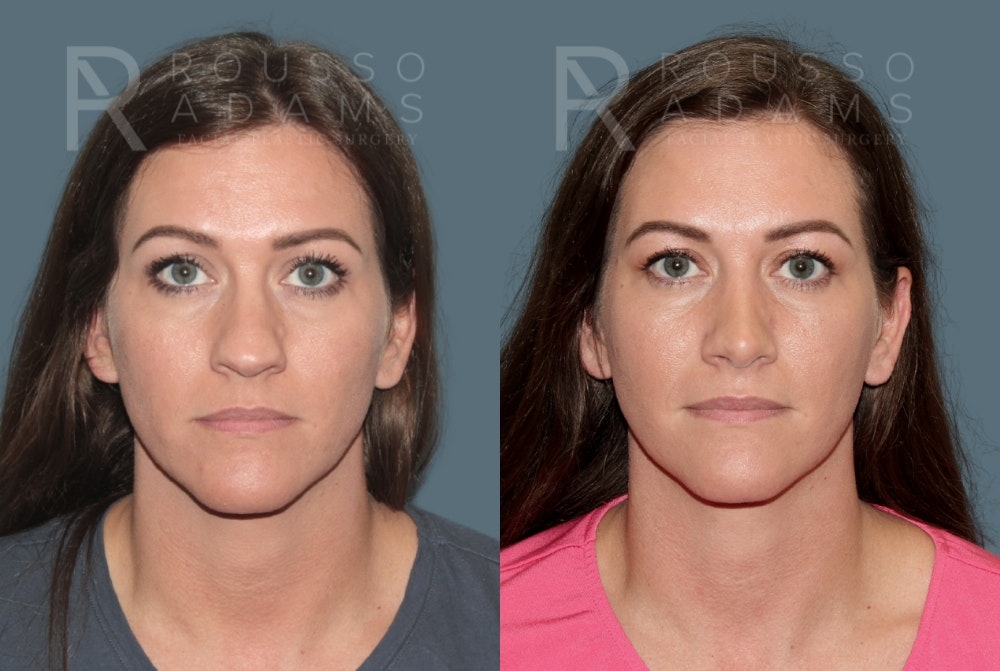 Rhinoplasty Before & After Gallery - Patient 325523 - Image 3