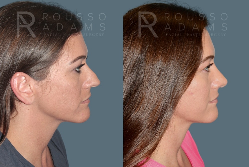Rhinoplasty Before & After Gallery - Patient 325523 - Image 1