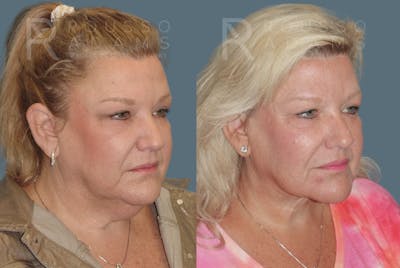 Facelift Before & After Gallery - Patient 1993300 - Image 1