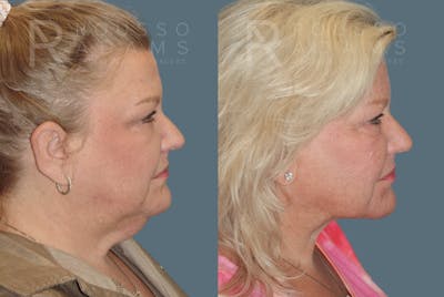Facelift <span class=small>By Dr. Daniel Rousso</span> Before & After Gallery - Patient 1993300 - Image 2