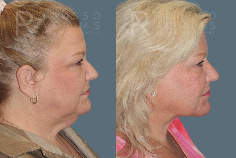 Facelift <span class=small>By Dr. Daniel Rousso</span> Before & After Gallery - Patient 1993300 - Image 2