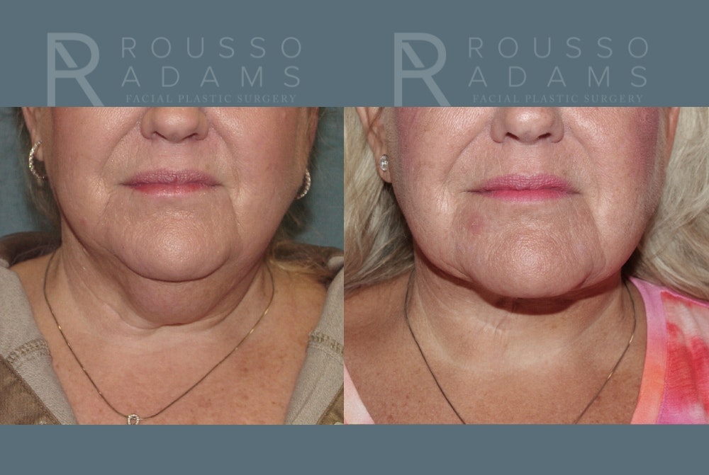 Facelift <span class=small>By Dr. Daniel Rousso</span> Before & After Gallery - Patient 1993300 - Image 3
