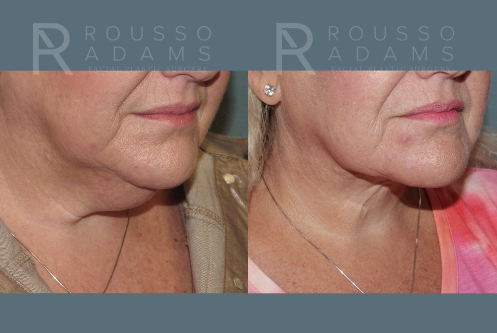 Facelift Before & After Gallery - Patient 1993300 - Image 4