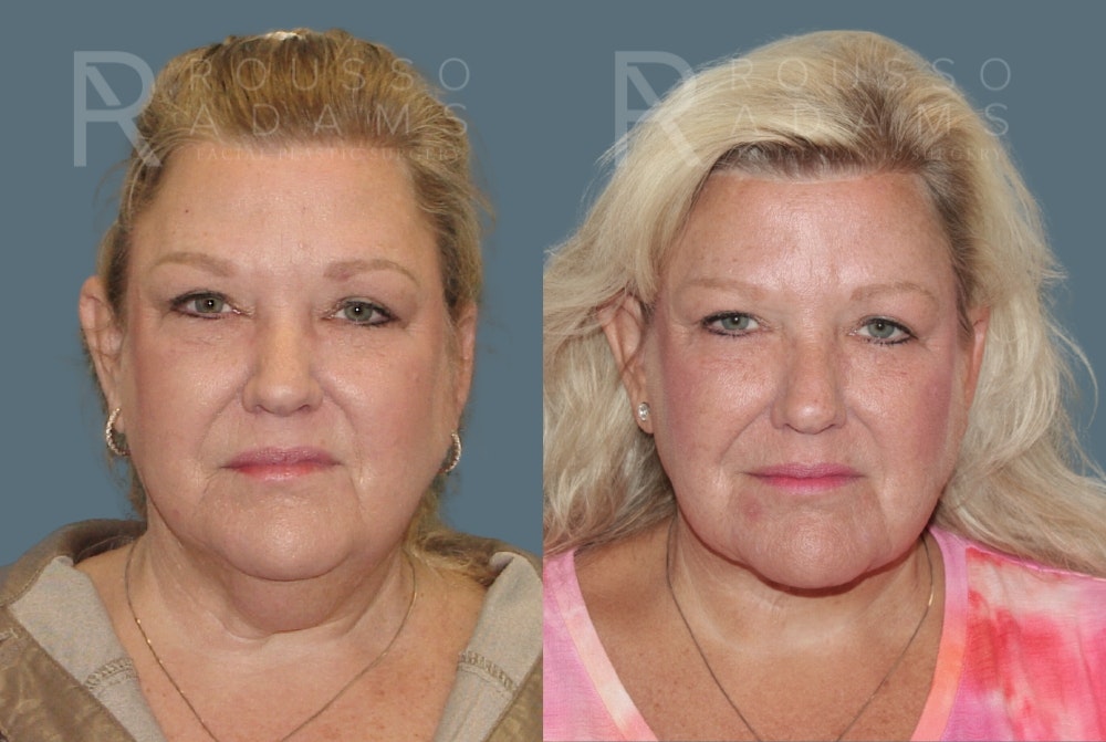 Facelift <span class=small>By Dr. Daniel Rousso</span> Before & After Gallery - Patient 1993300 - Image 5