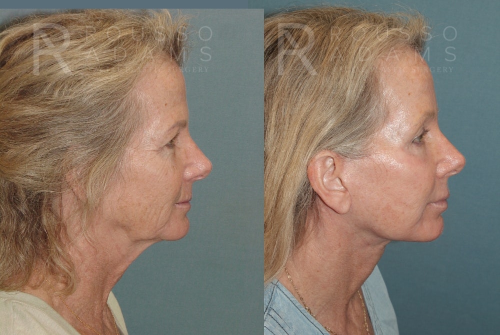 SculptLift™ Before & After Gallery - Patient 161218 - Image 3