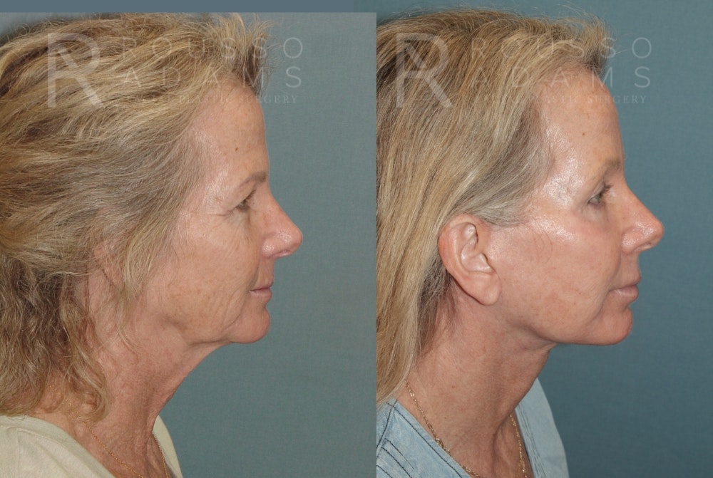 SculptLift™ <span class=small>By Dr. Daniel Rousso</span> Before & After Gallery - Patient 161218 - Image 3