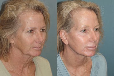 SculptLift™ <span class=small>By Dr. Daniel Rousso</span> Before & After Gallery - Patient 161218 - Image 2