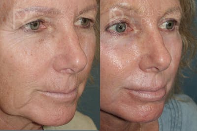 SculptLift™ <span class=small>By Dr. Daniel Rousso</span> Before & After Gallery - Patient 161218 - Image 4