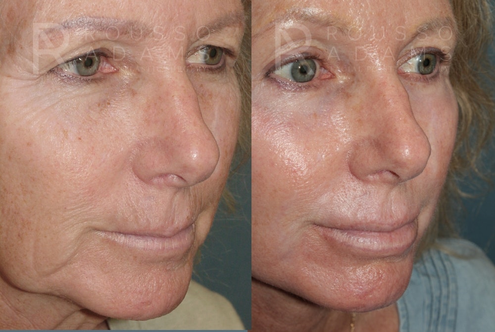 SculptLift™ <span class=small>By Dr. Daniel Rousso</span> Before & After Gallery - Patient 161218 - Image 4
