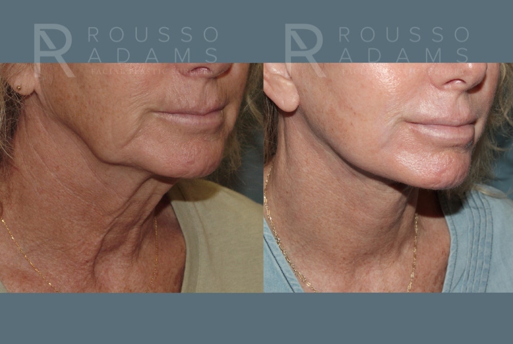 SculptLift™ <span class=small>By Dr. Daniel Rousso</span> Before & After Gallery - Patient 161218 - Image 5
