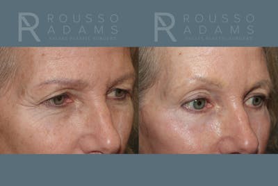 SculptLift™ <span class=small>By Dr. Daniel Rousso</span> Before & After Gallery - Patient 161218 - Image 6