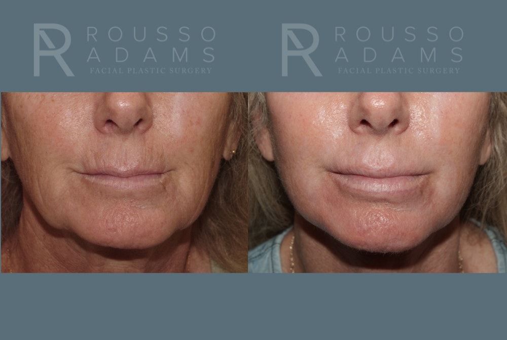 SculptLift™ <span class=small>By Dr. Daniel Rousso</span> Before & After Gallery - Patient 161218 - Image 7
