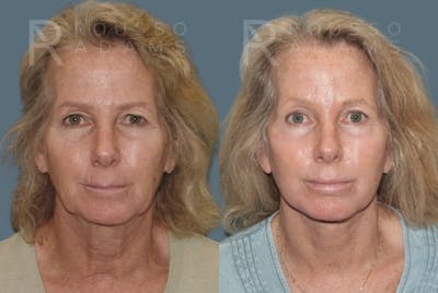 SculptLift™ <span class=small>By Dr. Daniel Rousso</span> Before & After Gallery - Patient 161218 - Image 1