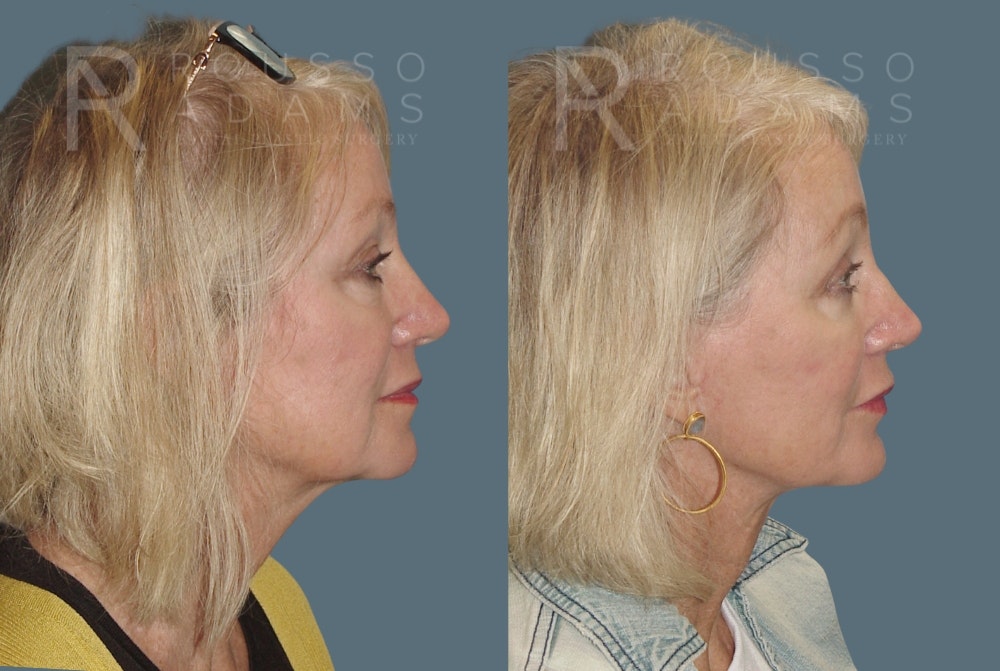 SculptLift™ <span class=small>By Dr. Daniel Rousso</span> Before & After Gallery - Patient 310033 - Image 3