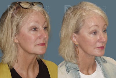 SculptLift™ <span class=small>By Dr. Daniel Rousso</span> Before & After Gallery - Patient 310033 - Image 2