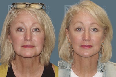 SculptLift™ <span class=small>By Dr. Daniel Rousso</span> Before & After Gallery - Patient 310033 - Image 1