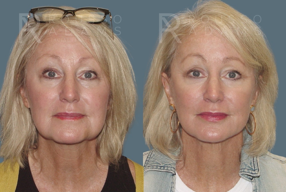 SculptLift™ Before & After Gallery - Patient 310033 - Image 1