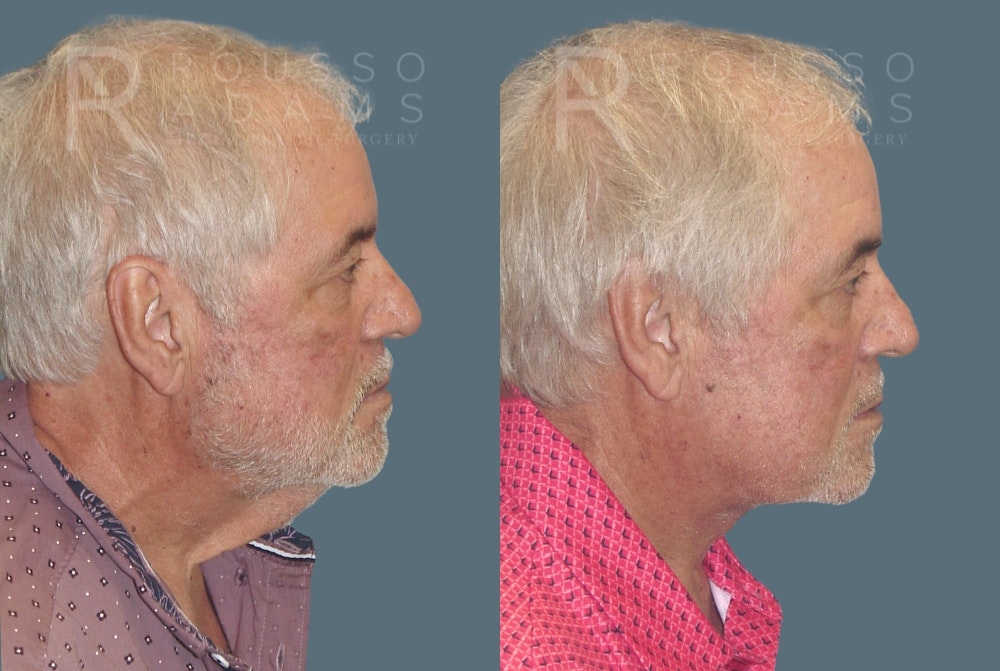 Male Facelift <span class=small>By Dr. Daniel Rousso</span> Before & After Gallery - Patient 586287 - Image 3