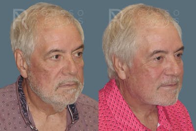 Male Facelift <span class=small>By Dr. Daniel Rousso</span> Before & After Gallery - Patient 586287 - Image 2