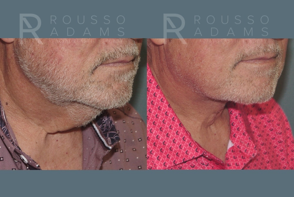 Male Facelift Before & After Gallery - Patient 586287 - Image 4