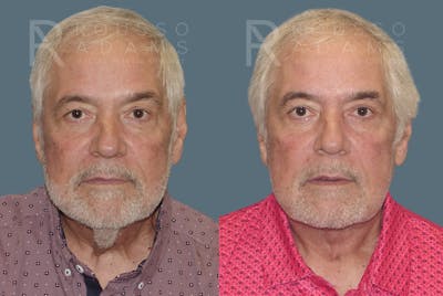 Male Facelift Before & After Gallery - Patient 586287 - Image 1