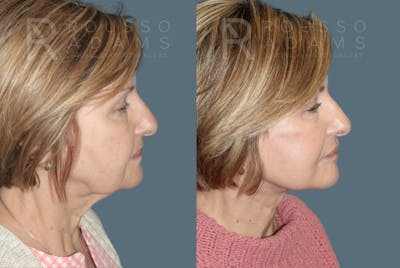 Deep Plane Facelift Before & After Gallery - Patient 406952 - Image 2