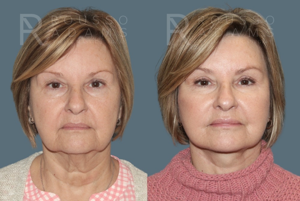 Deep Plane Facelift Before & After Gallery - Patient 406952 - Image 3